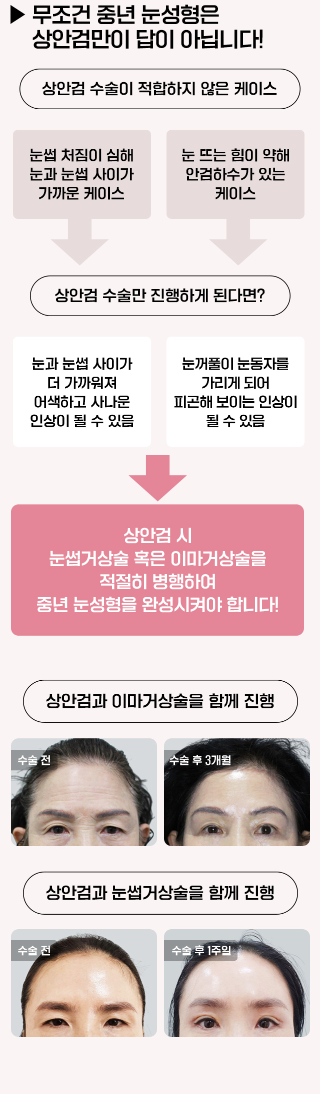 눈썹이마거상술